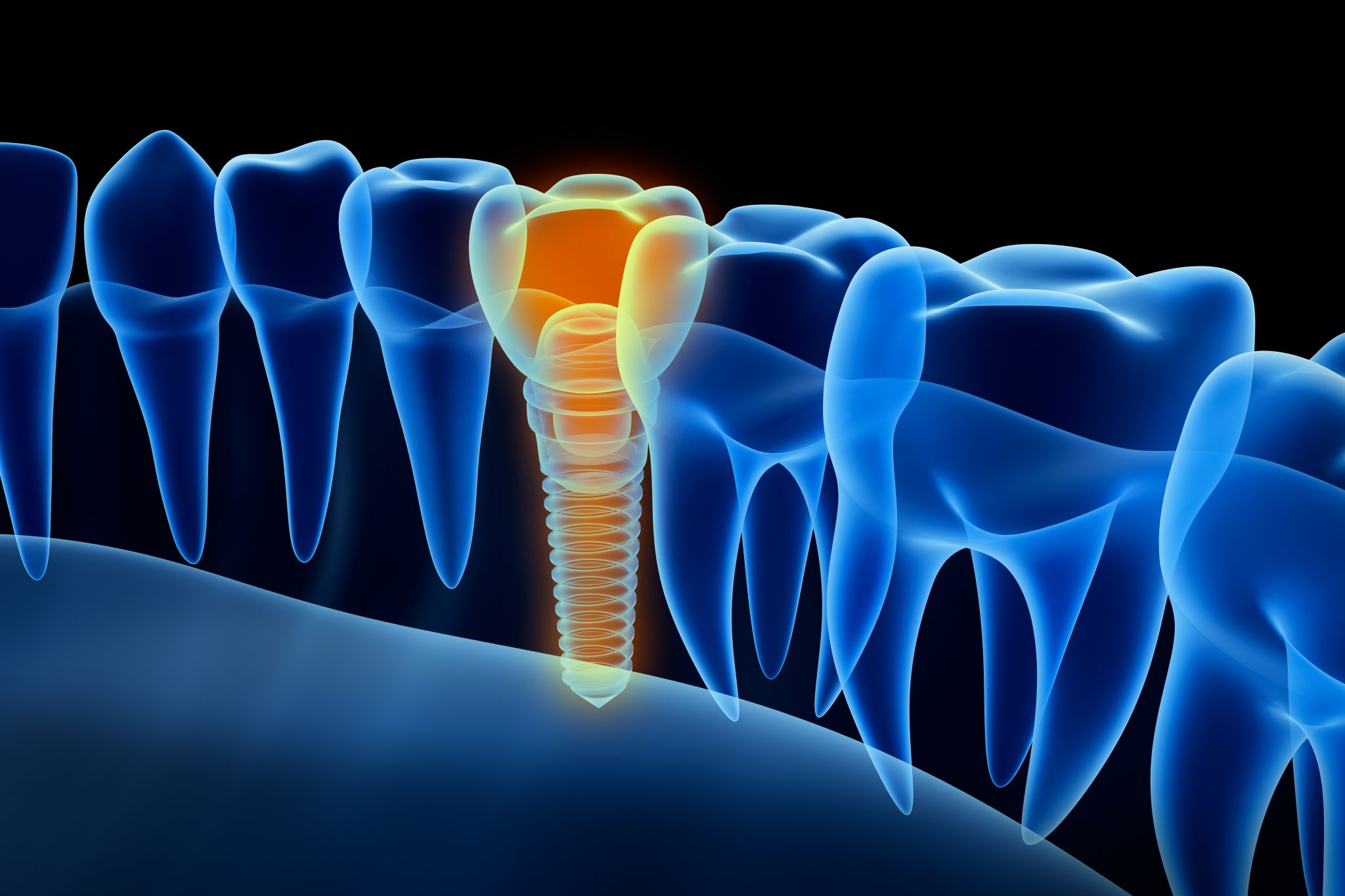 impianti dentali impianti dentali