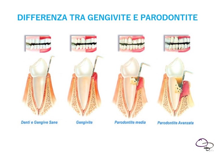 gengivite e parodontite gengivite e parodontite