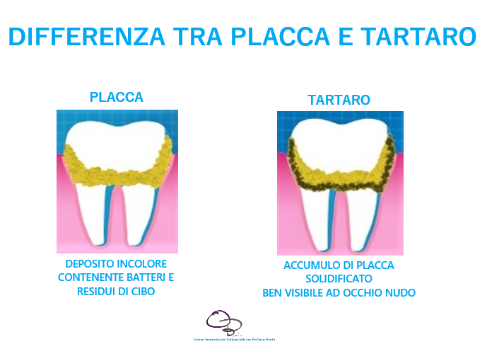 placca e tartaro