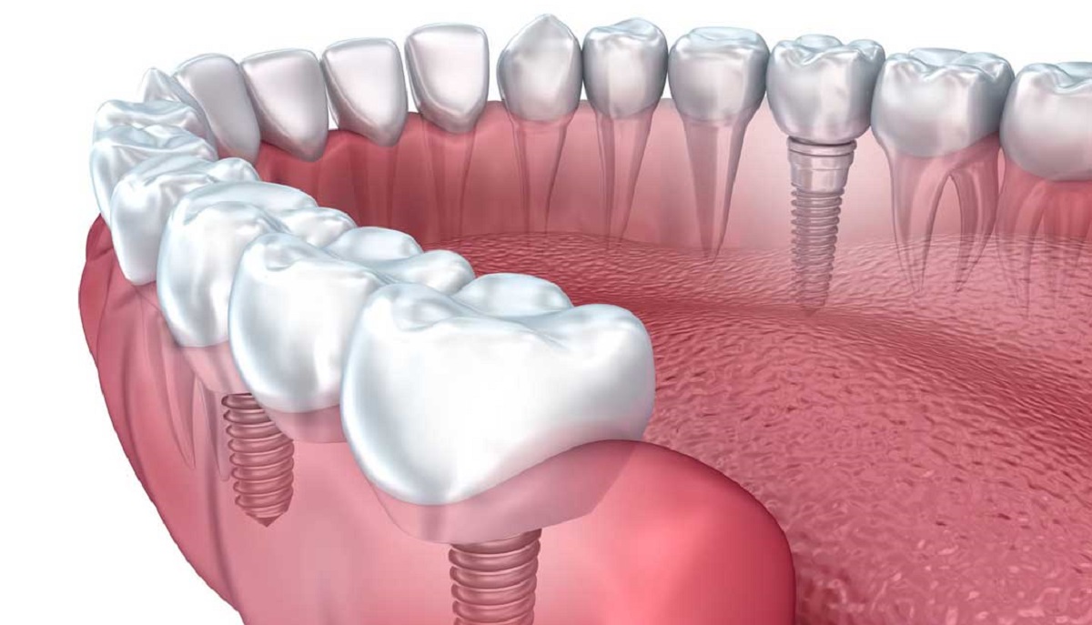 implantologia-dentale
