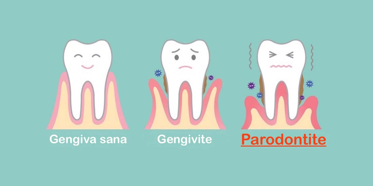 cause-rimedi-parodontite