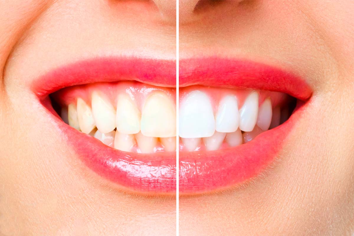 cause-macchie-denti
