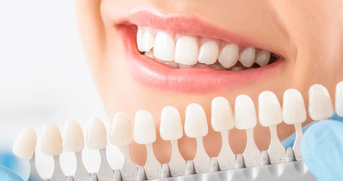 faccette-dentali-ceramica-estetica